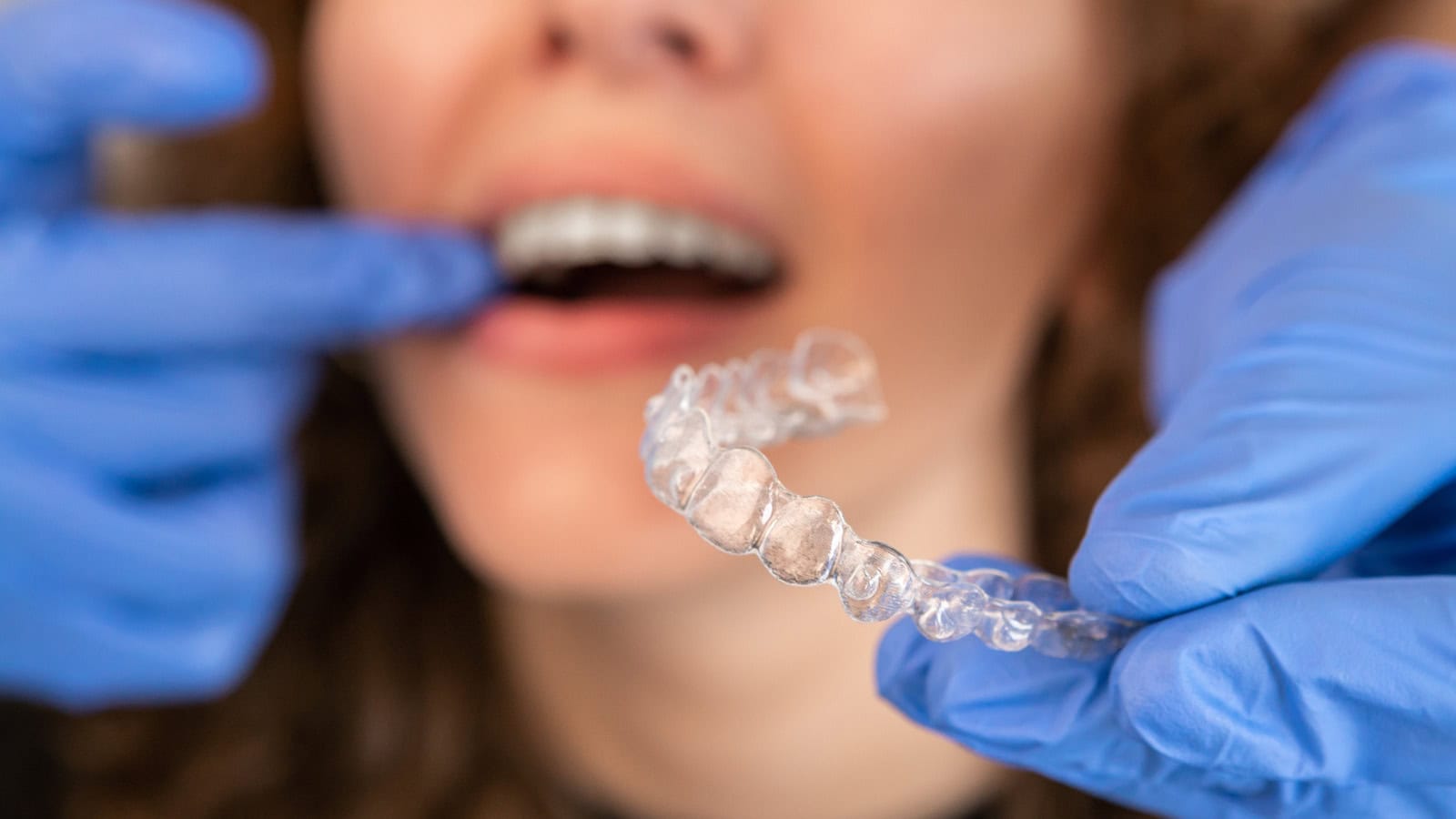Does Dental Insurance Cover Invisalign in St. Augustine?