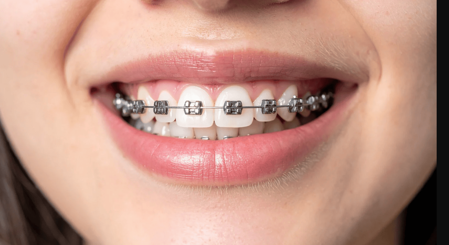 What Does Adult Orthodontic Treatment Cost in St. Augustine?