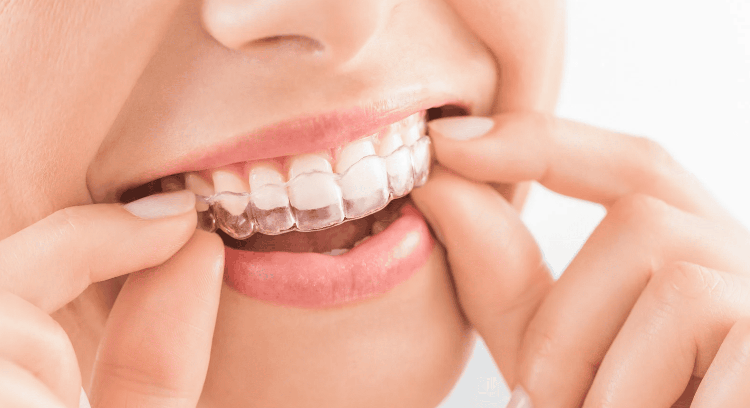Ways to Lower the Cost of Invisalign for Teens
