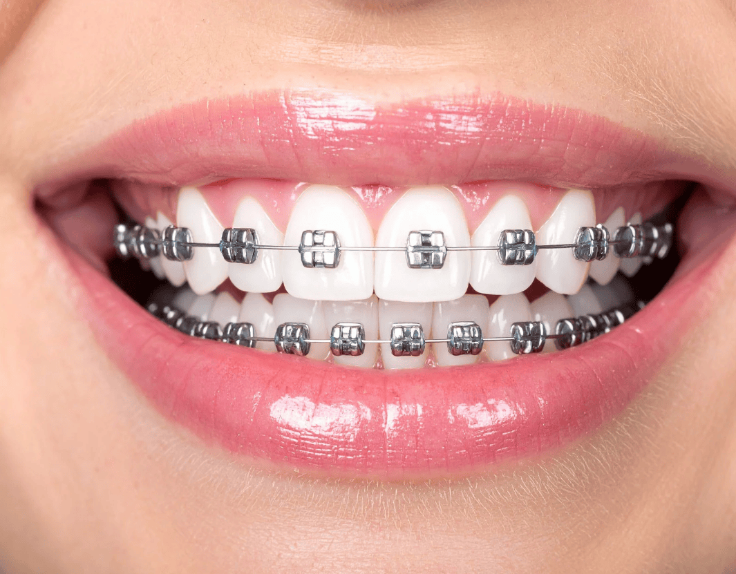 What Determines the Cost of Braces in St. Augustine?