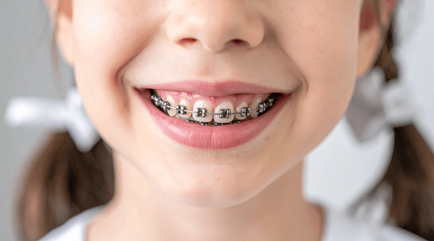 Braces Pricing for Children, Teens, and Adults
