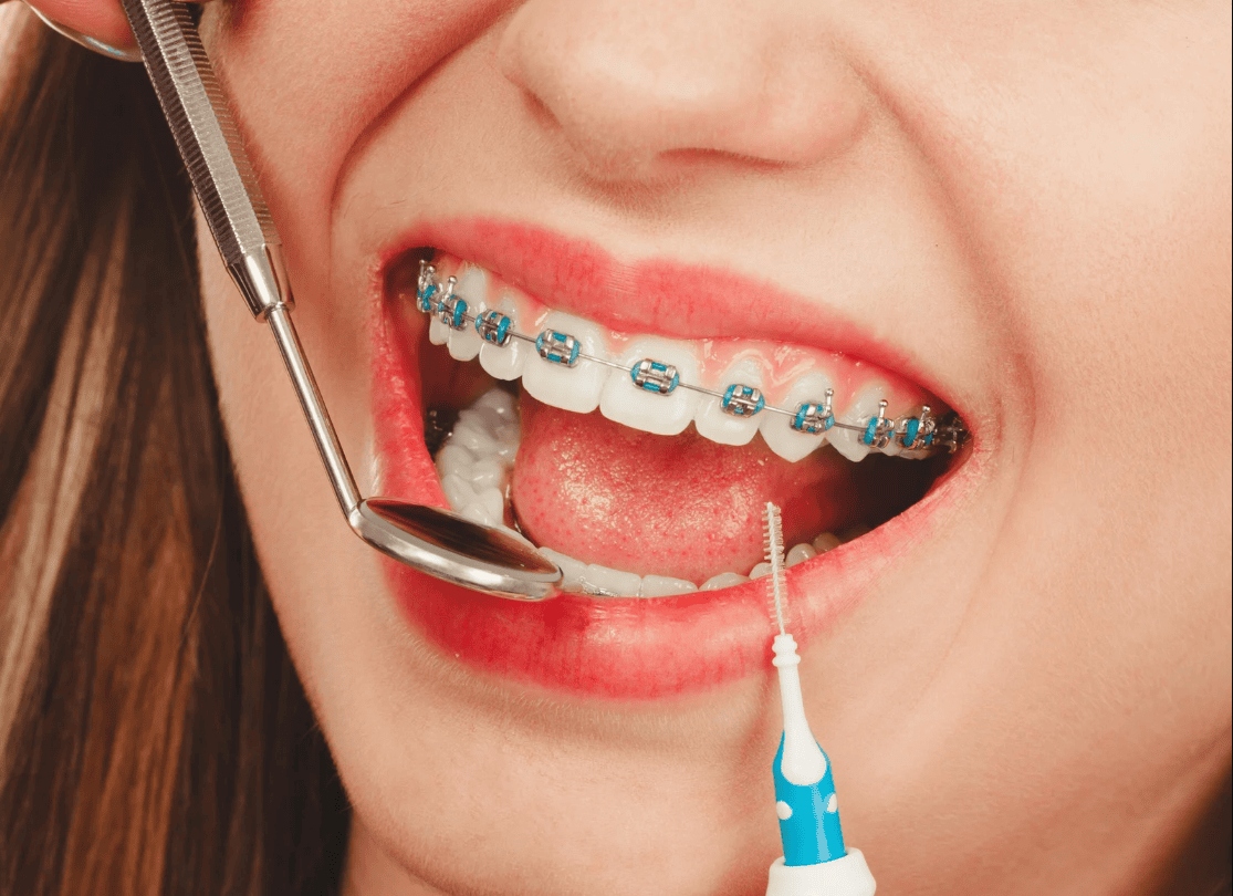 What Types of Braces Are Available in St. Augustine?