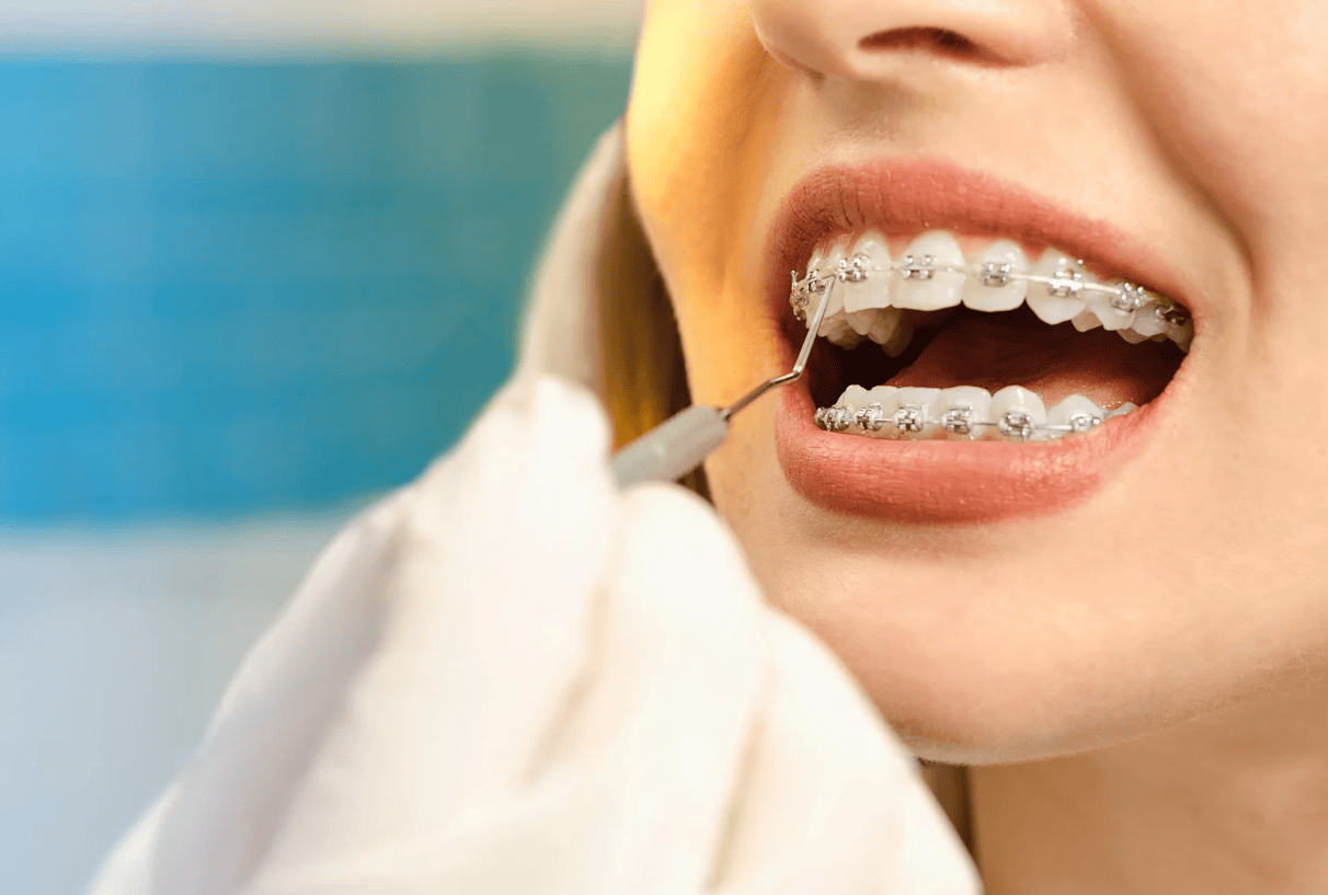 Key Factors to Consider When Choosing Braces