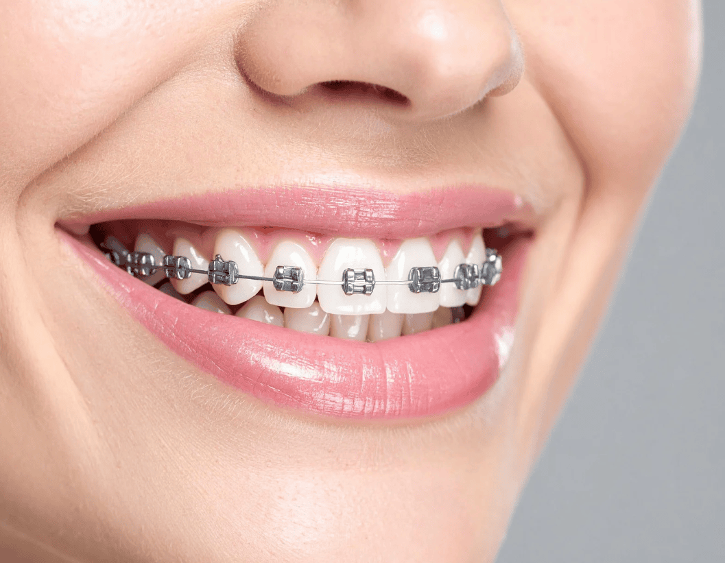 What Happens During the First Few Days With Braces?