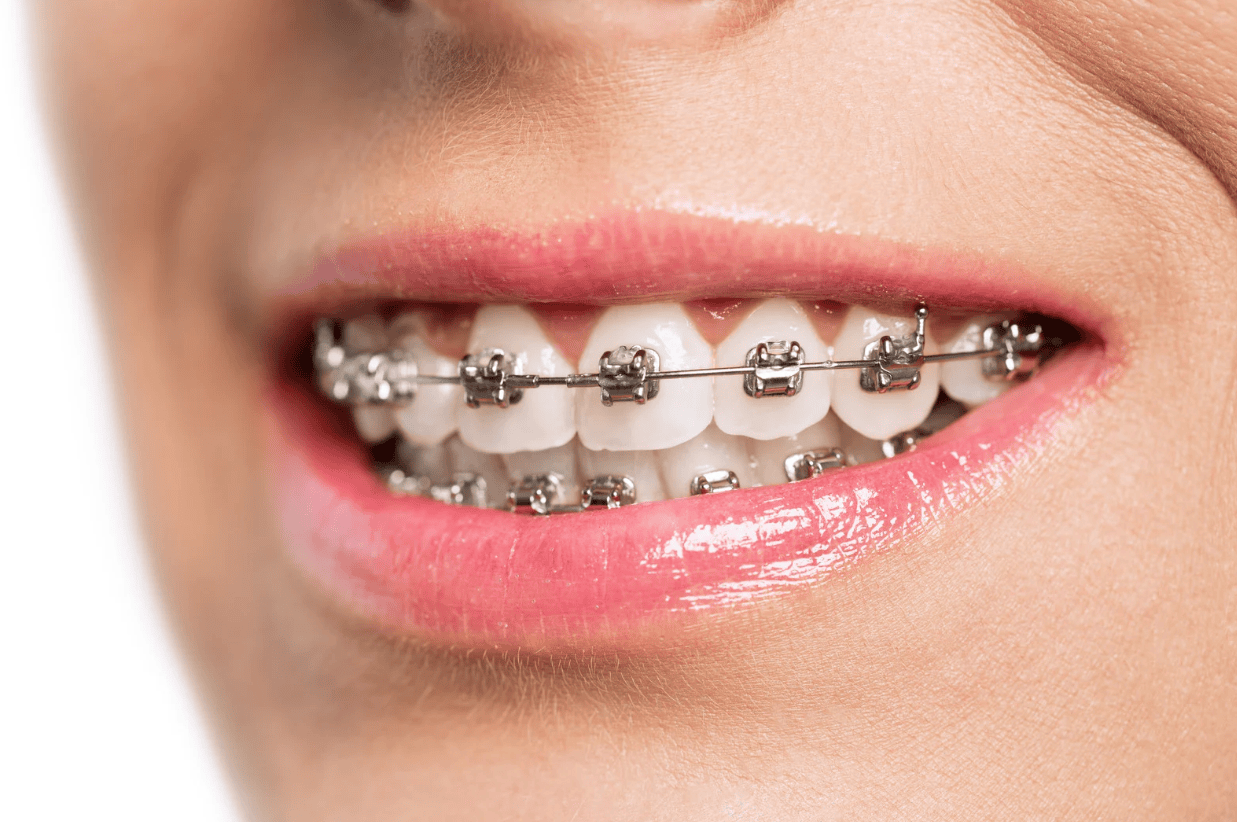Tips for Quick Relief From Braces Soreness