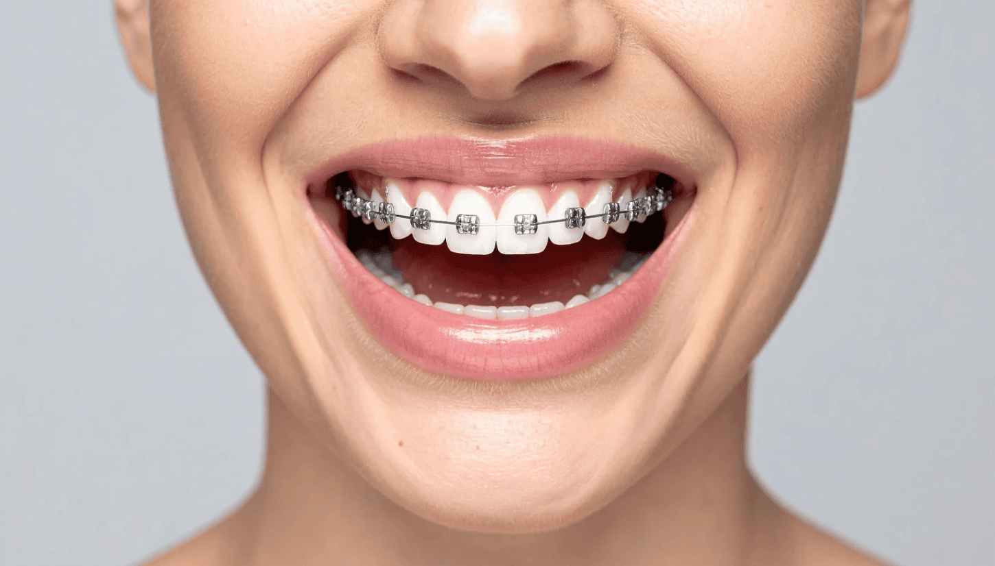 How Much Do Braces Cost by Appliance Type?