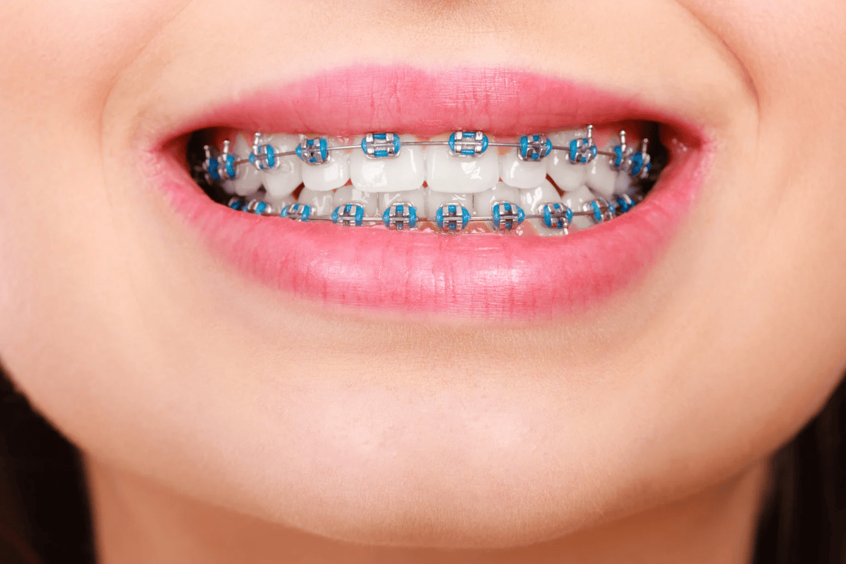 Factors That Affect Braces Treatment Duration