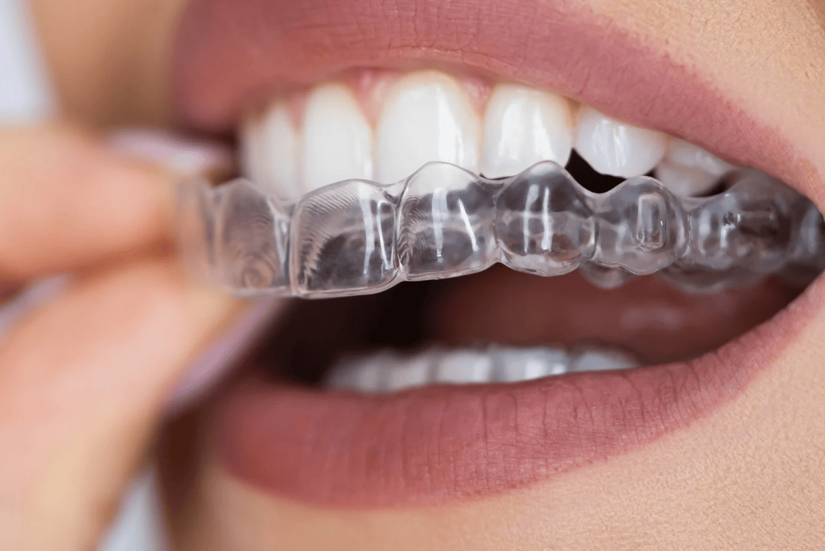 What Happens During the Clear Aligner Treatment Process?